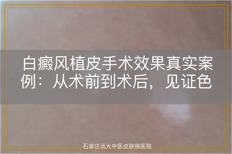 白癜风植皮手术效果真实案例：从术前到术后，见证色素再生奇迹