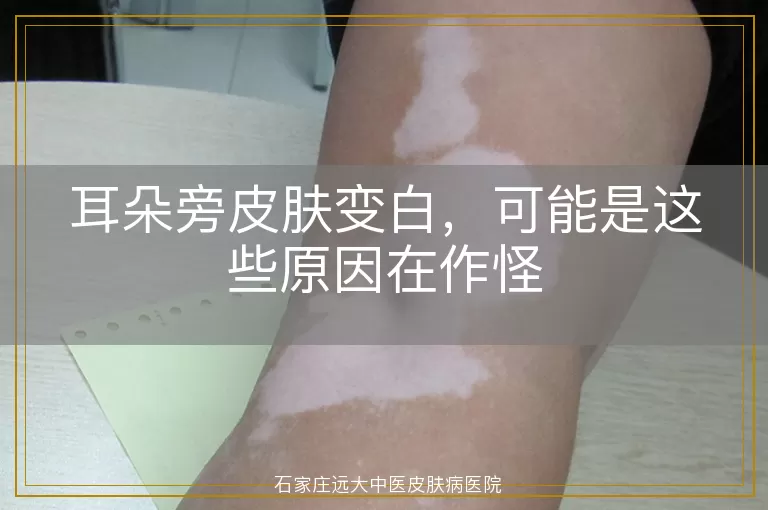耳朵旁皮肤变白，可能是这些原因在作怪