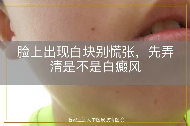 脸上出现白块别慌张，先弄清是不是白癜风