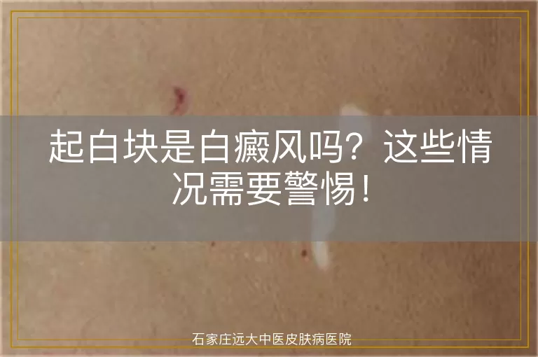 起白块是白癜风吗?这些情况需要警惕!