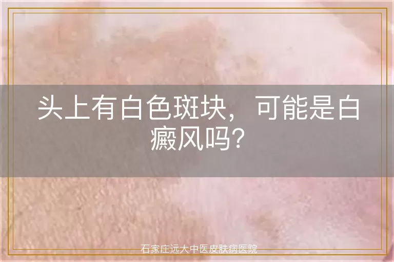 头上有白色斑块，可能是白癜风吗？
