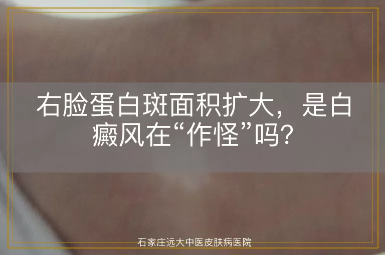 右脸蛋白斑面积扩大，是白癜风在“作怪”吗？