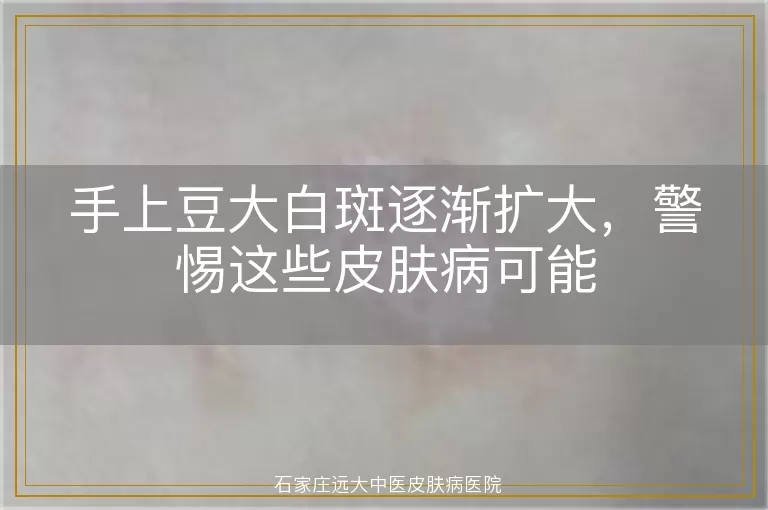 手上豆大白斑逐渐扩大，警惕这些皮肤病可能