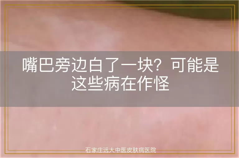 嘴巴旁边白了一块？可能是这些病在作怪