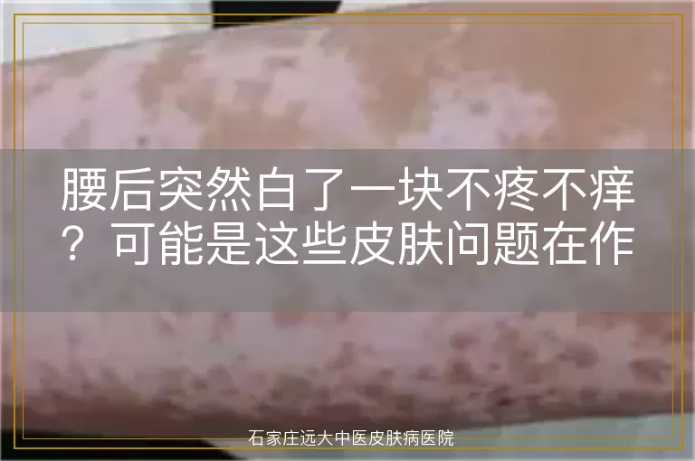 腰后突然白了一块不疼不痒？可能是这些皮肤问题在作祟