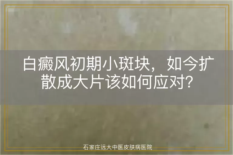 白癜风初期小斑块，如今扩散成大片该如何应对？