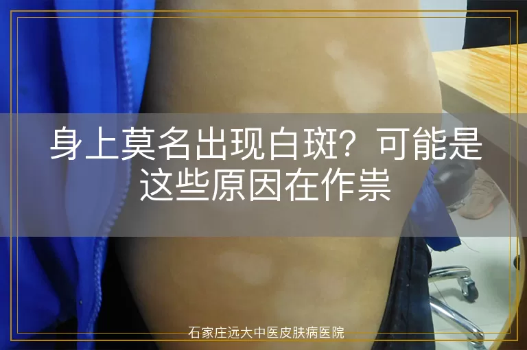 身上莫名出现白斑？可能是这些原因在作祟