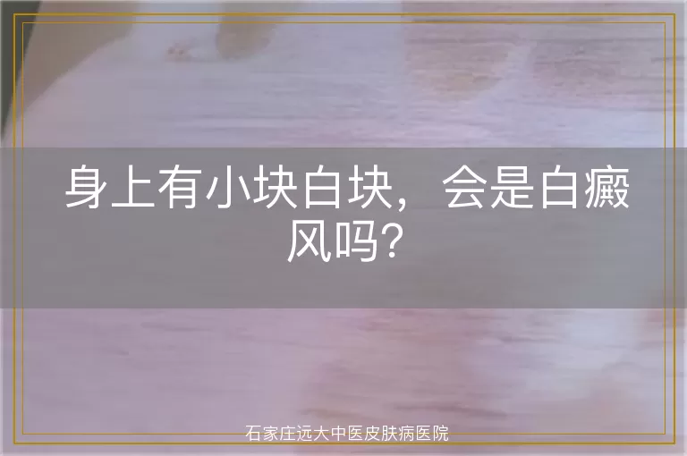 身上有小块白块，会是白癜风吗？