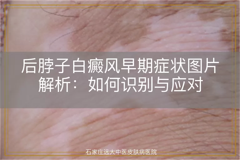 后脖子白癜风早期症状图片解析：如何识别与应对