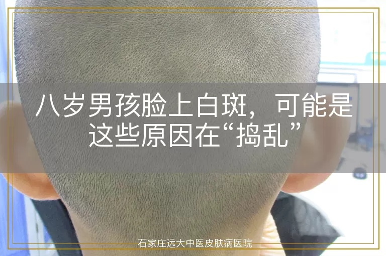 八岁男孩脸上白斑，可能是这些原因在“捣乱”