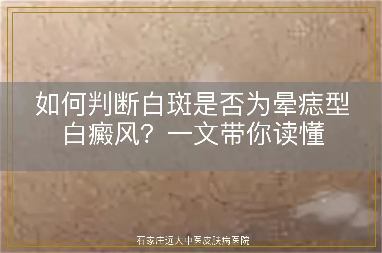 如何判断白斑是否为晕痣型白癜风？一文带你读懂