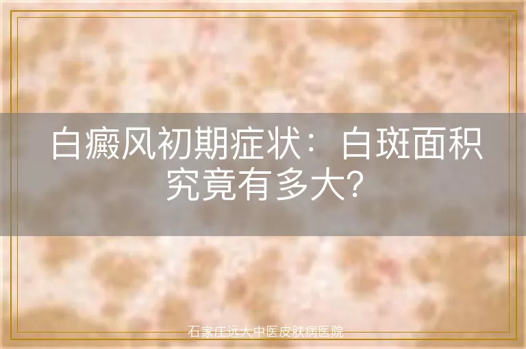 白癜风初期症状：白斑面积究竟有多大？