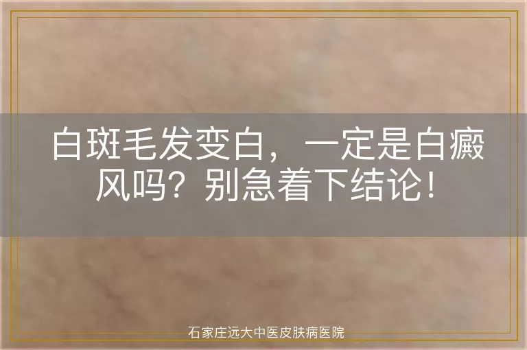 白斑毛发变白，一定是白癜风吗？别急着下结论！