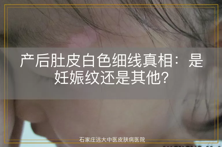 产后肚皮白色细线真相：是妊娠纹还是其他？