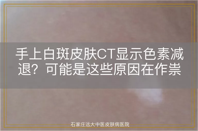 手上白斑皮肤CT显示色素减退？可能是这些原因在作祟