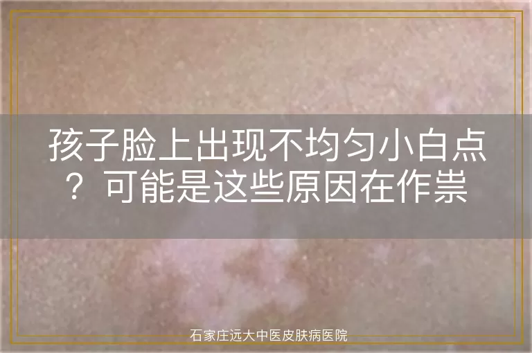 孩子脸上出现不均匀小白点？可能是这些原因在作祟