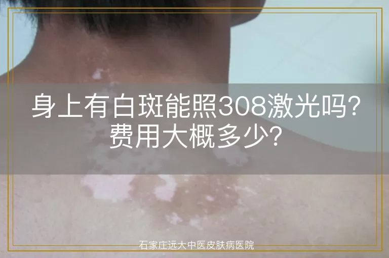 身上有白斑能照308激光吗？费用大概多少？