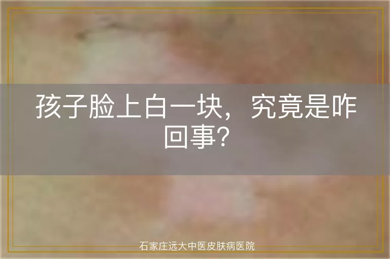 孩子脸上白一块，究竟是咋回事？
