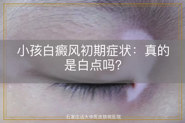 小孩白癜风初期症状：真的是白点吗？
