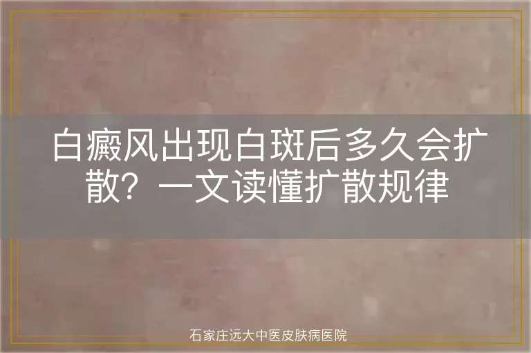 白癜风出现白斑后多久会扩散？一文读懂扩散规律