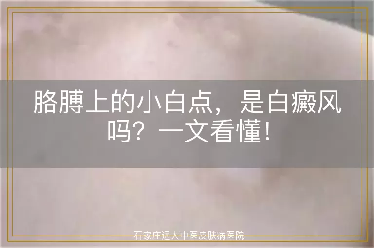 胳膊上的小白点，是白癜风吗？一文看懂！