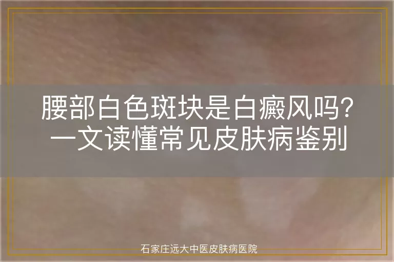 腰部白色斑块是白癜风吗？一文读懂常见皮肤病鉴别