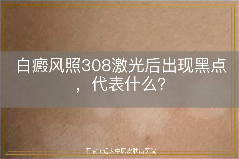 白癜风照308激光后出现黑点，代表什么？