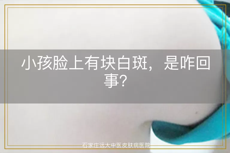 小孩脸上有块白斑，是咋回事？