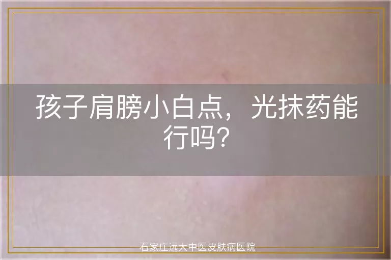 孩子肩膀小白点，光抹药能行吗？