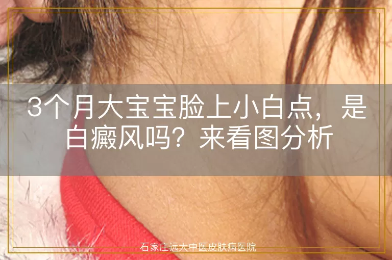3个月大宝宝脸上小白点，是白癜风吗？来看图分析