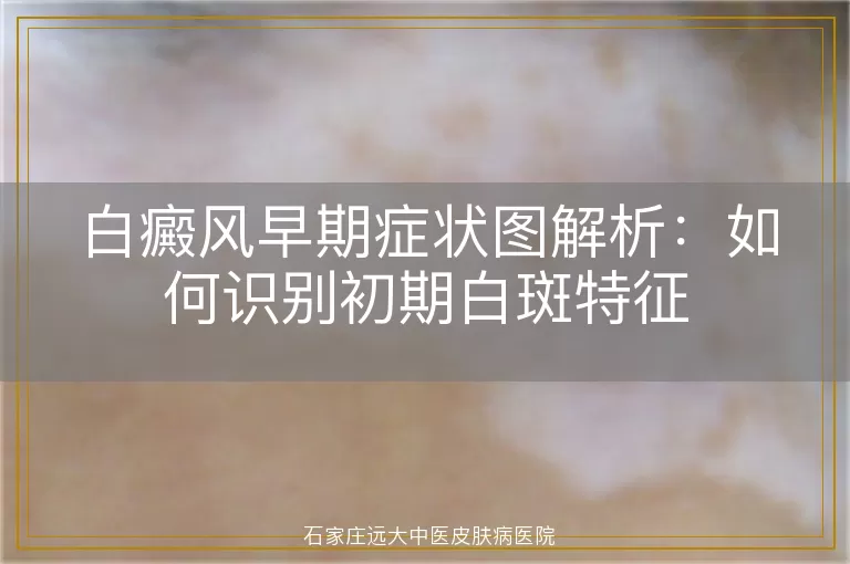 白癜风早期症状图解析：如何识别初期白斑特征