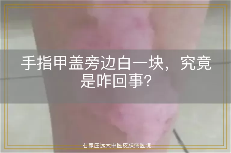 手指甲盖旁边白一块，究竟是咋回事？