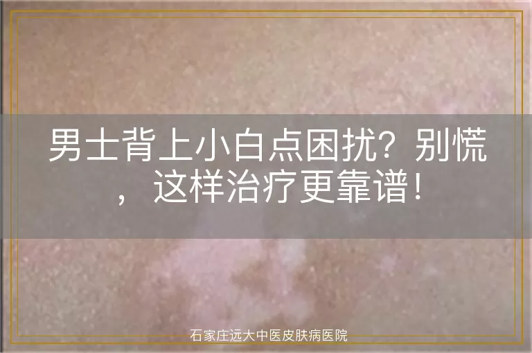 男士背上小白点困扰？别慌，这样治疗更靠谱！