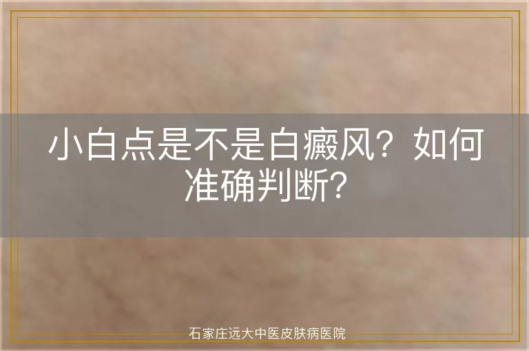 小白点是不是白癜风？如何准确判断？