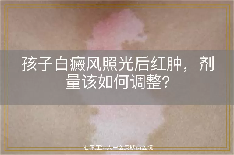 孩子白癜风照光后红肿，剂量该如何调整？