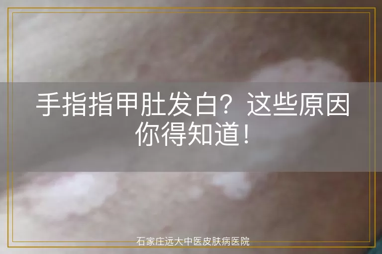 手指指甲肚发白？这些原因你得知道！