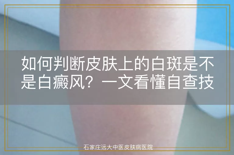 如何判断皮肤上的白斑是不是白癜风？一文看懂自查技巧