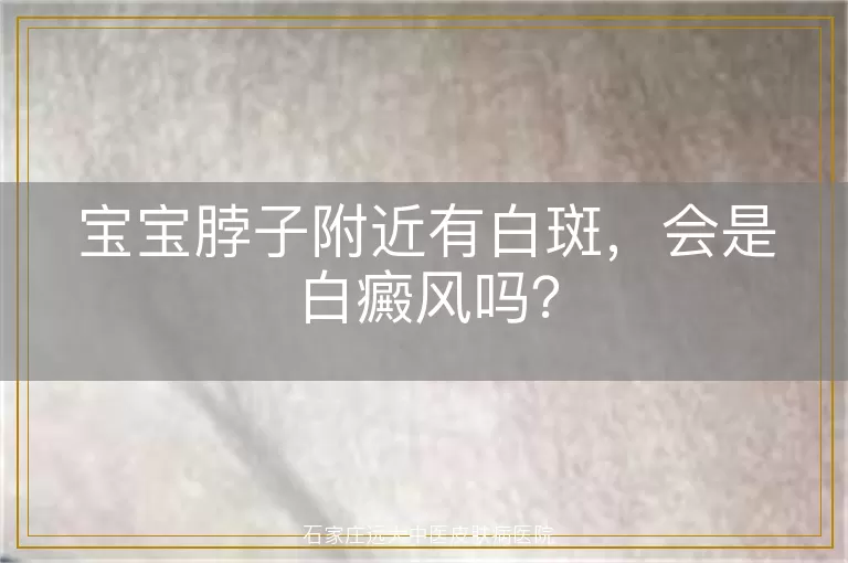 宝宝脖子附近有白斑，会是白癜风吗？