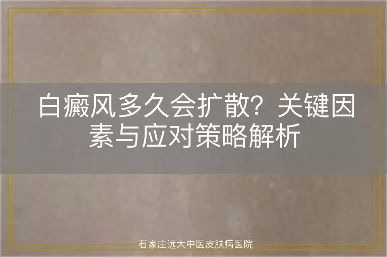 白癜风多久会扩散？关键因素与应对策略解析