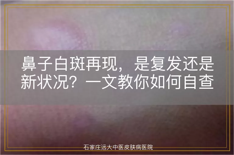 鼻子白斑再现，是复发还是新状况？一文教你如何自查与就医
