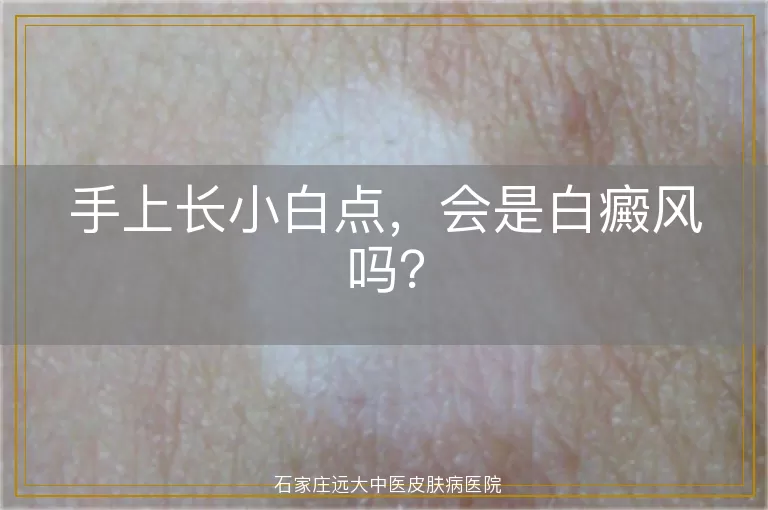 手上长小白点，会是白癜风吗？