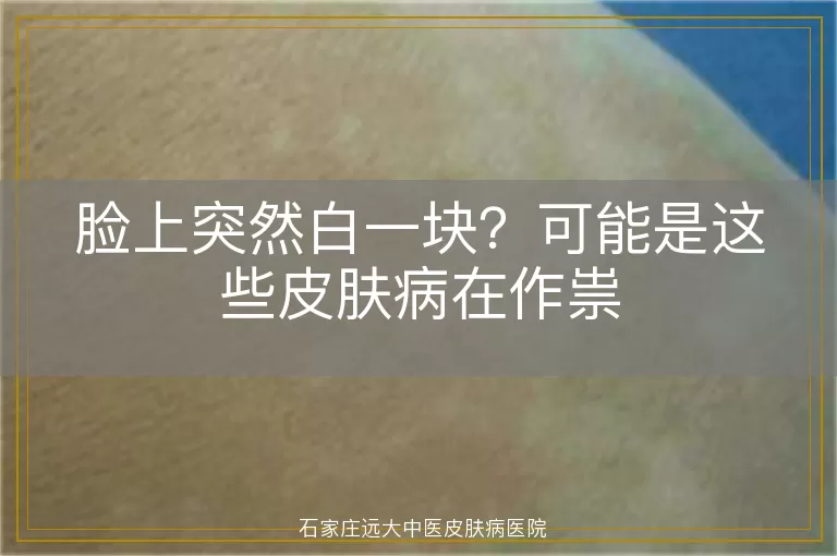 脸上突然白一块？可能是这些皮肤病在作祟