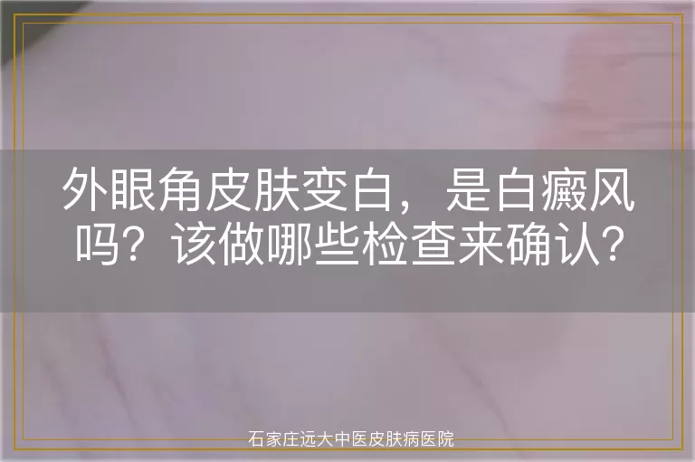 外眼角皮肤变白，是白癜风吗？该做哪些检查来确认？