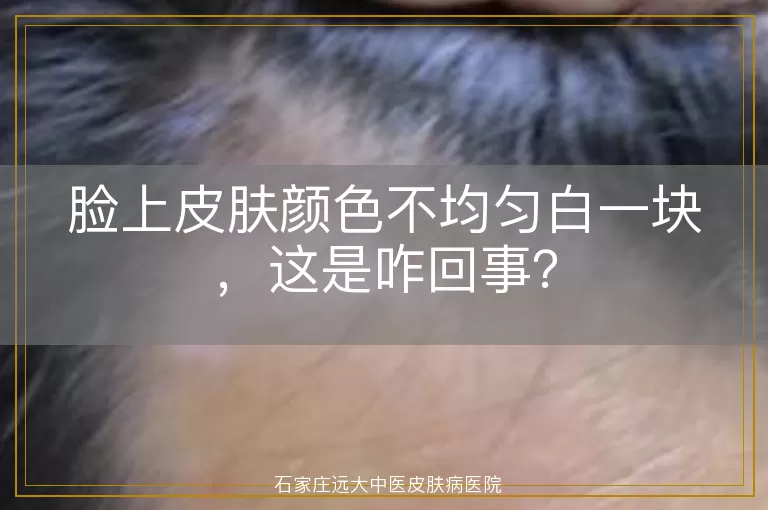 脸上皮肤颜色不均匀白一块，这是咋回事？