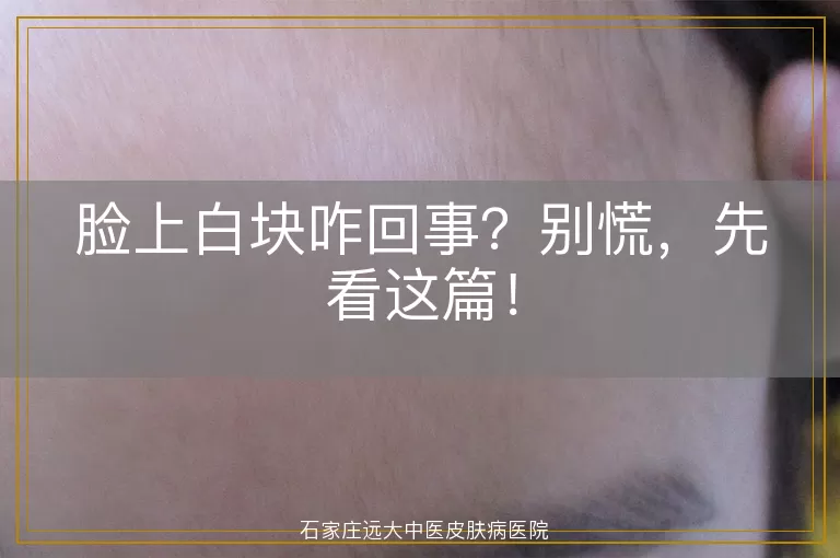 脸上白块咋回事？别慌，先看这篇！