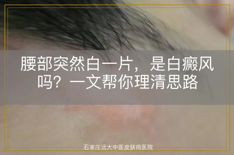 腰部突然白一片,是白癜风吗?一文帮你理清思路