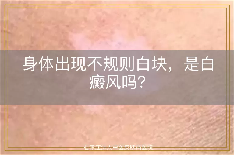 身体出现不规则白块，是白癜风吗？