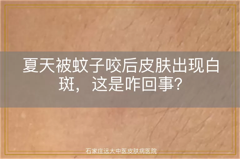 夏天被蚊子咬后皮肤出现白斑，这是咋回事？