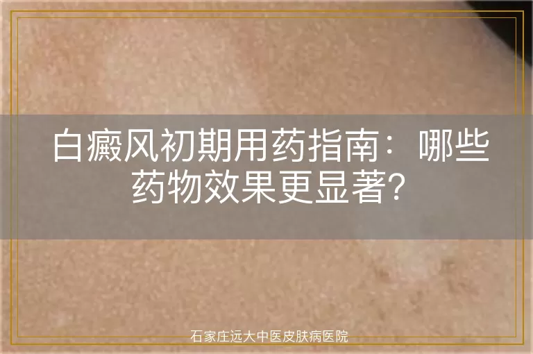 白癜风初期用药指南：哪些药物效果更显著？
