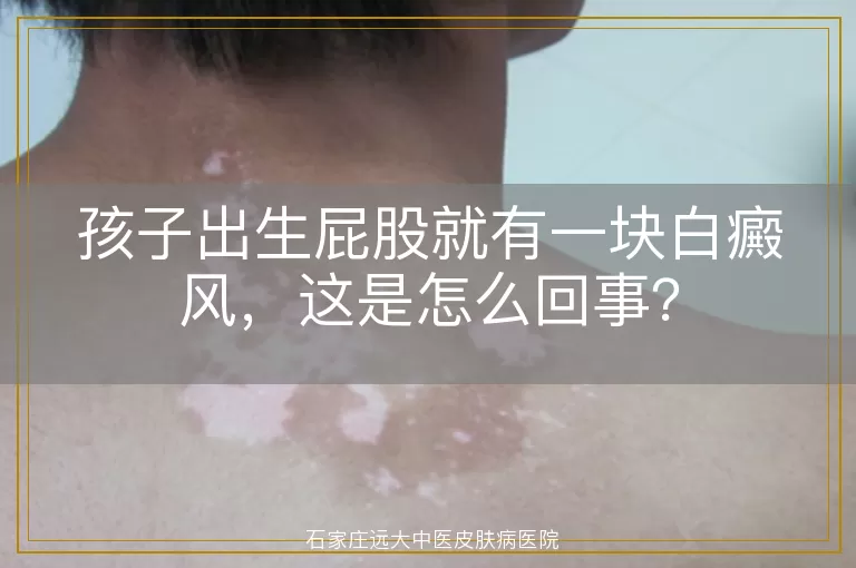 孩子出生屁股就有一块白癜风，这是怎么回事？
